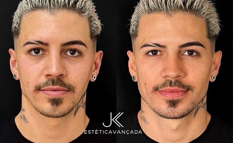 Biel realiza sua primeira harmonização facial na clínica JK Estética Avançada em São Paulo